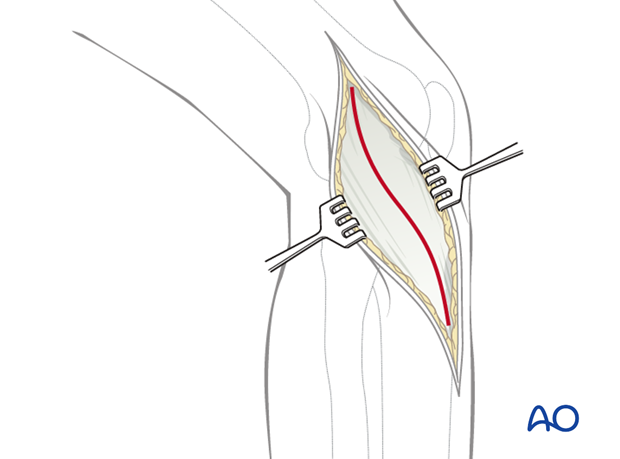 anterolateral approach