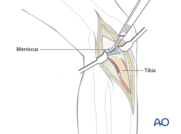 anterolateral approach