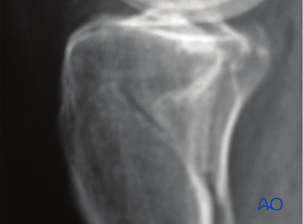 posterior approach