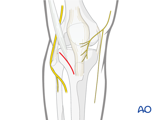 Approach for minimally invasive osteosynthesis (MIO)