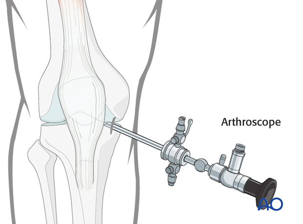 approach for minimally invasive osteosynthesis mio