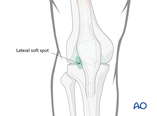 Identify the lateral soft spot adjacent to the patellar tendon