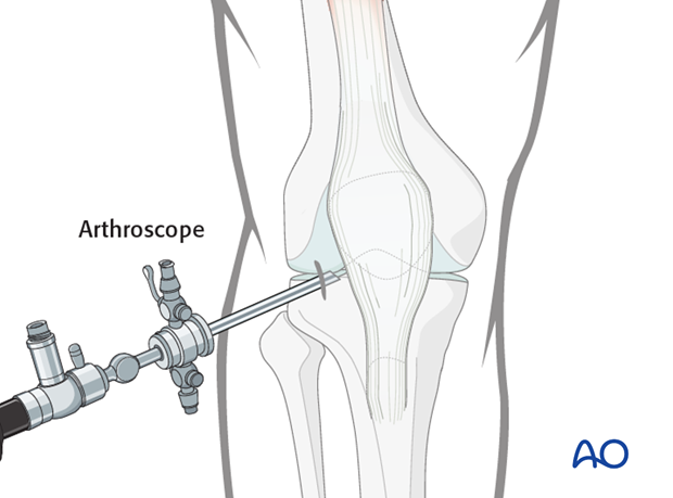 Make a 5 mm stab incision and insert the arthroscopic shaft carefully, so as not to damage the intraarticular cartilage surface.