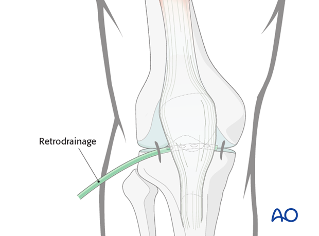 arthroscopic approach to the knee