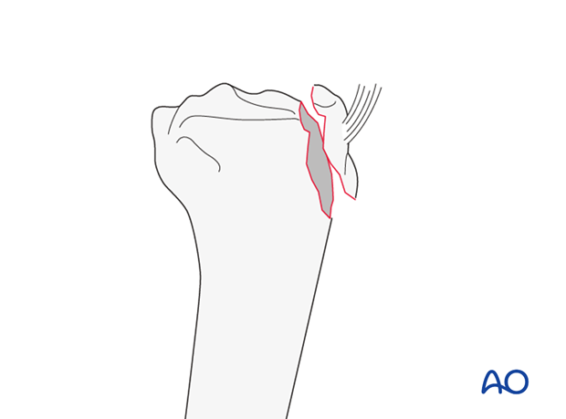 Tibial tubercle (AO/OTA 41A1.2)