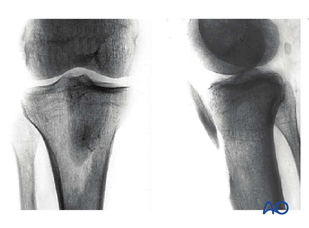 Tibial tubercle (AO/OTA 41A1.2)