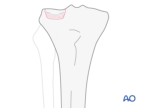 Partial articular fracture, depression