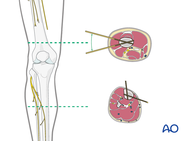 bridging external fixator temporary