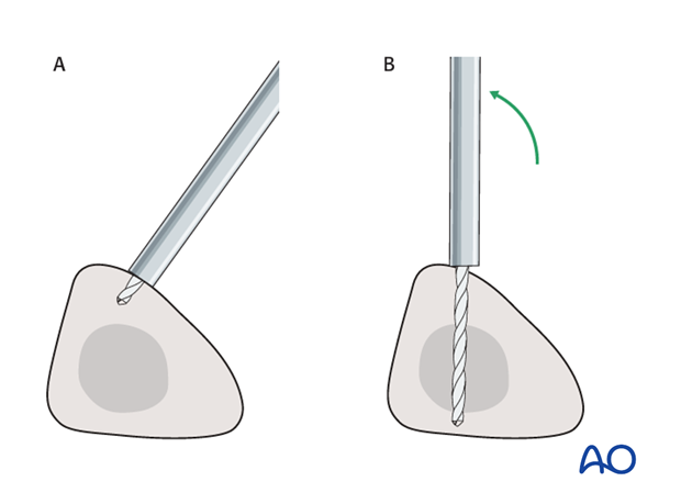 bridging external fixator temporary