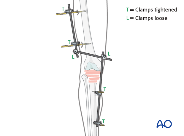 bridging external fixator temporary