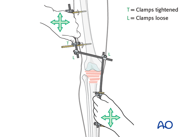 bridging external fixator temporary