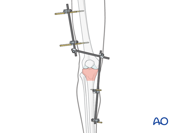 complete articular fracture simple articular multifragmentary metaphyseal