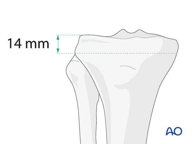 Ring external fixator (definitive) for Complete articular fracture ...