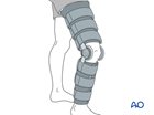 complete articular fracture simple articular multifragmentary metaphyseal