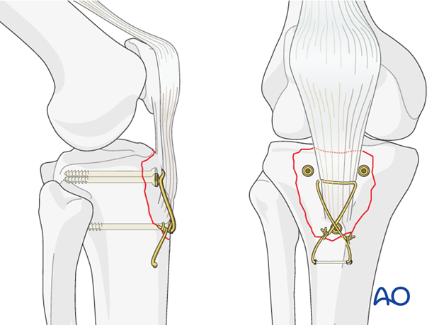 extraarticular fracture avulsion of tibial tubercle