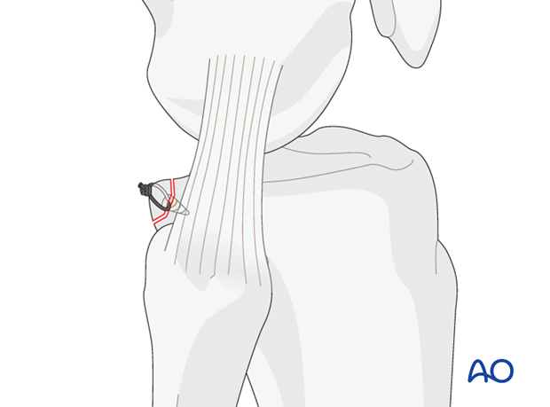 extraarticular fracture avulsion of tibial tubercle