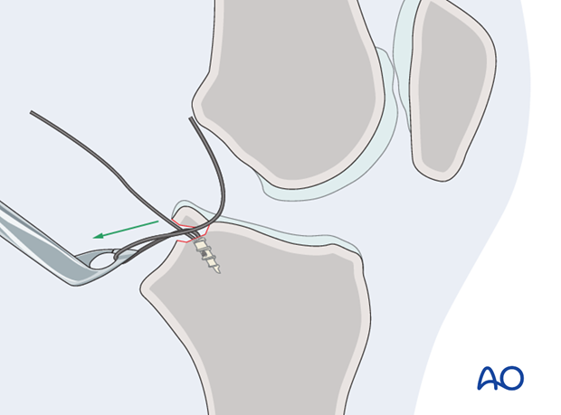 suture anchors