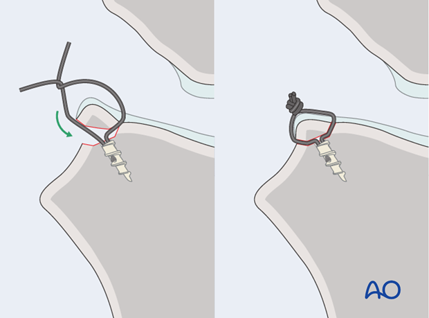 suture anchors