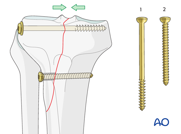 lag screw technique