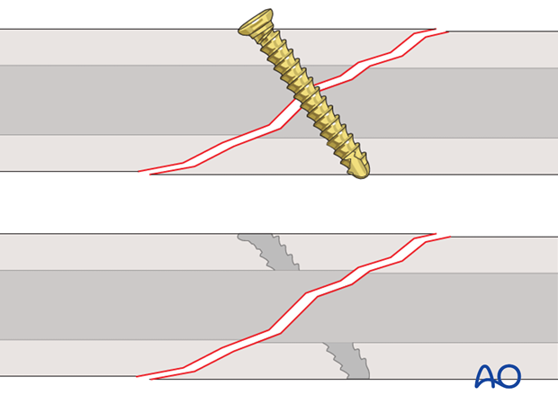 lag screw technique