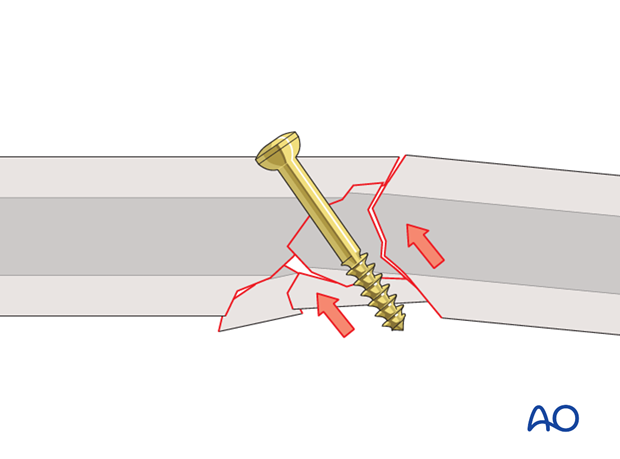 lag screw technique