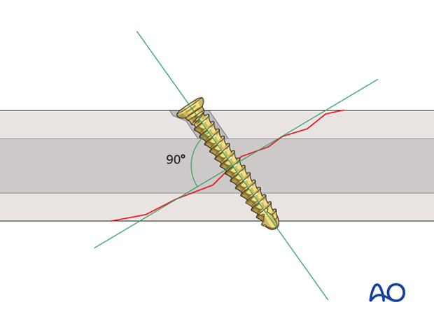 lag screw technique