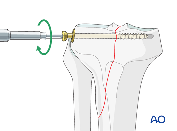 lag screw technique