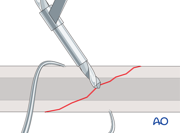 lag screw technique