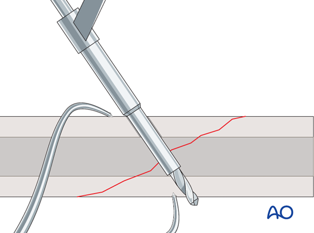 lag screw technique