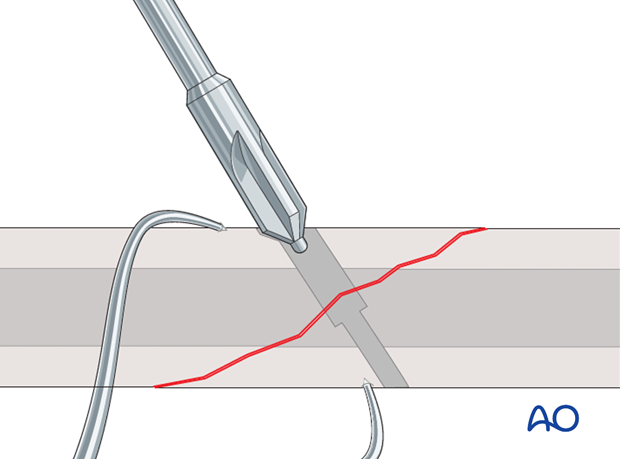 lag screw technique