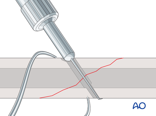 lag screw technique