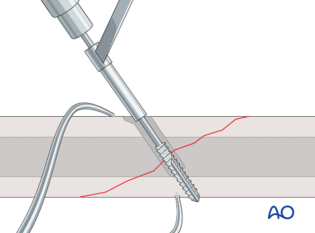 lag screw technique