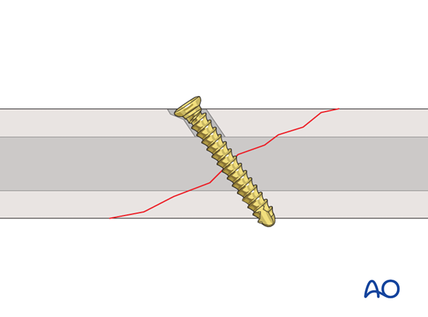 lag screw technique