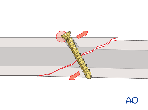 lag screw technique