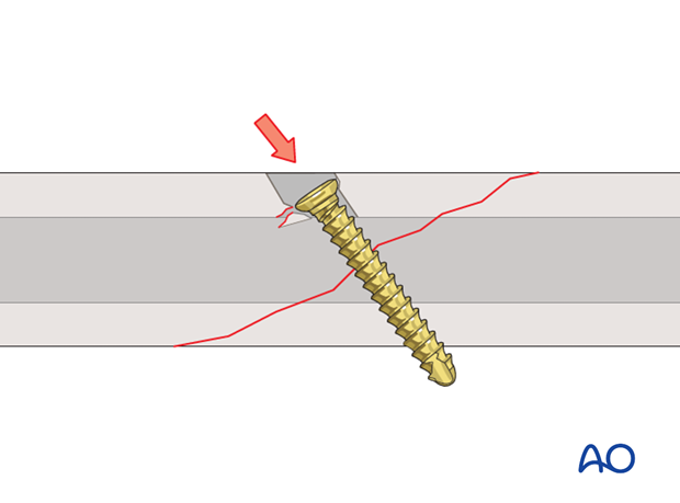 lag screw technique