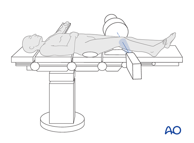 Positioning for optimal lateral view of the proximal tibia