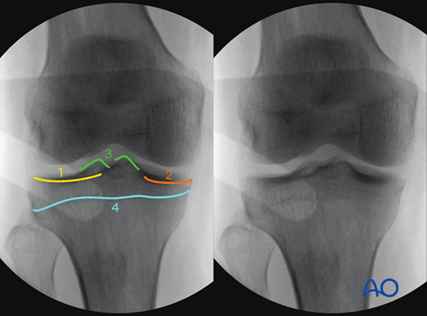 Anatomical landmarks and lines in the AP view of the proximal tibia with 10° cephalic tilt