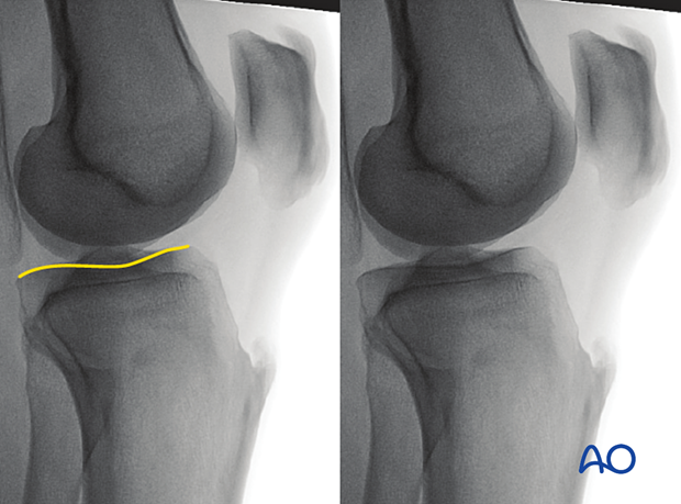 41 X552 Intraoperative imaging of the proximal tibia