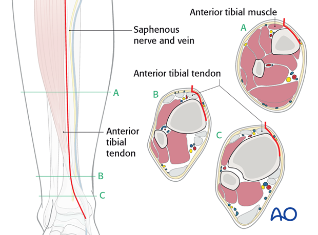 Take care not to compromise the great saphenous vein and nerve.