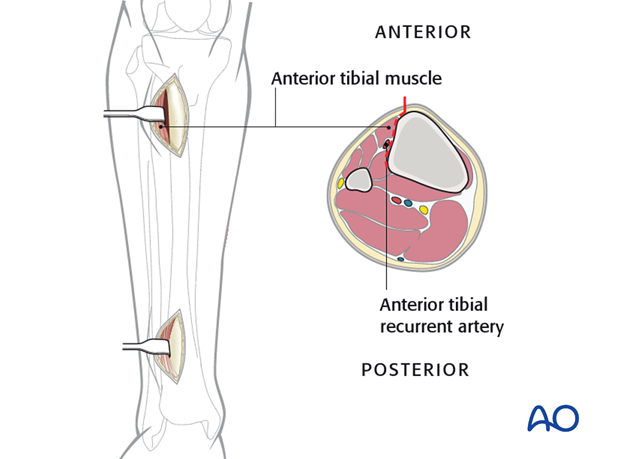 Proximal incision