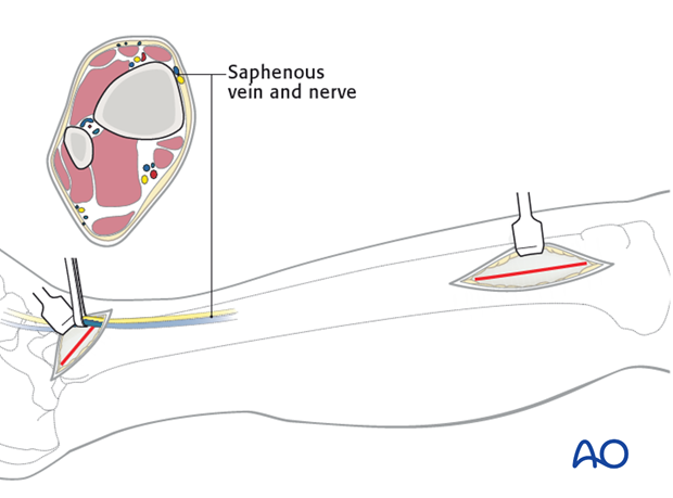 Deepen the dissection to the periosteum, which is left intact.