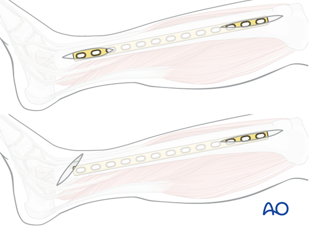 The straight incision is more direct, but leaves an incision right over the plate.