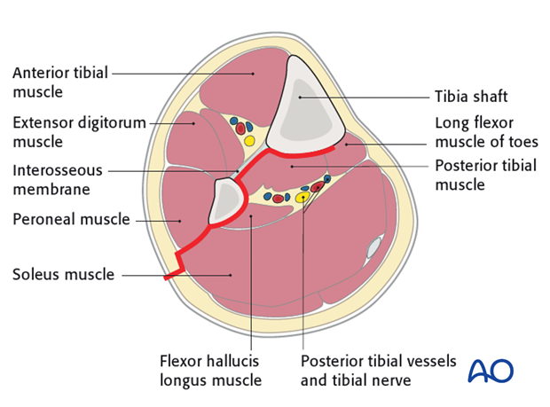 The posterolateral approach can be used for open plate fixation of the tibia on its posterior surface.