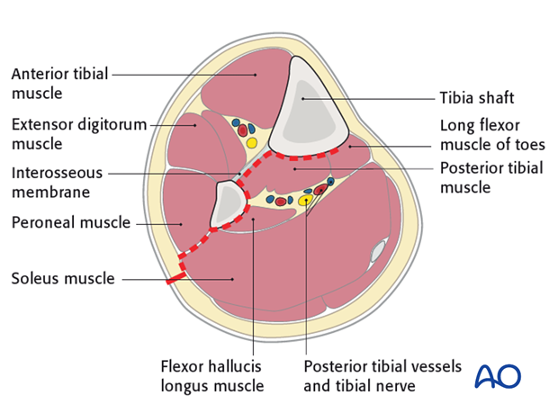 The interval between the lateral and posterior compartments is usually easier to find distally.