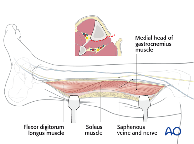 The fascia is then incised in line with the skin incision and the superficial and deep posterior compartments are mobilized. 