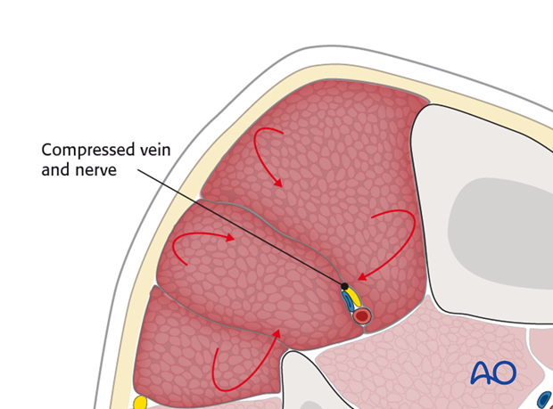 compartment syndrome