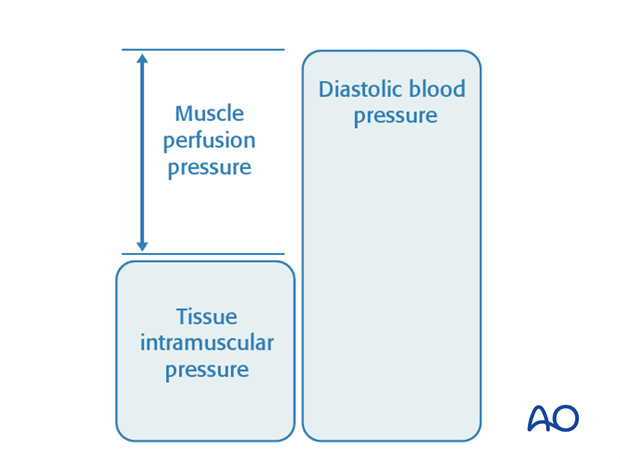 compartment syndrome