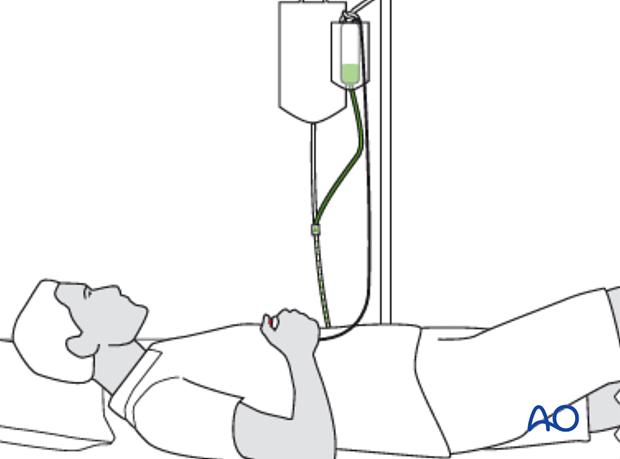 compartment syndrome