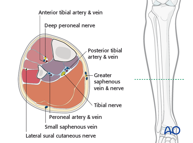 compartment syndrome