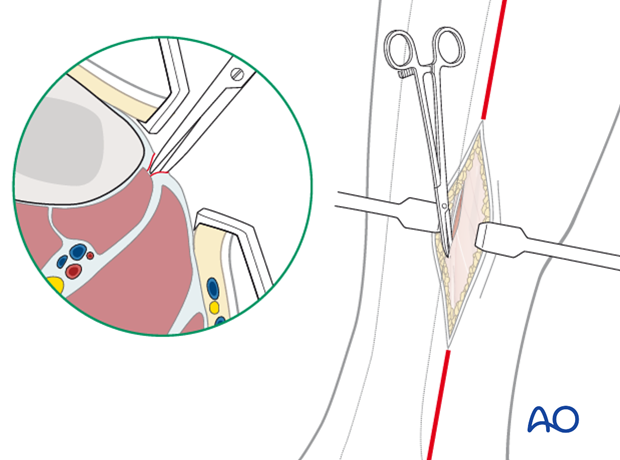 compartment syndrome